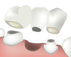 ブリッジ治療とは？