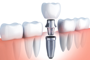 「抜けた歯の最良の治療法はインプラント」という歯医者は多い